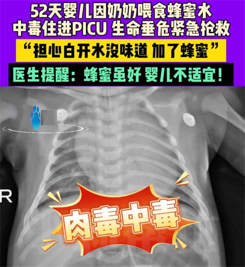 52天婴儿喝奶奶喂的蜂蜜水中毒进ICU